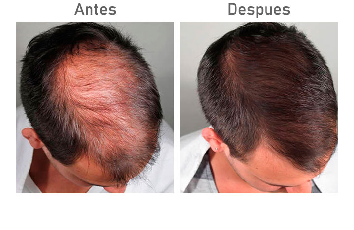 Antes despues