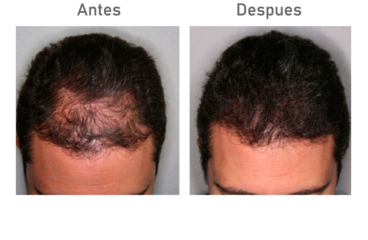 Antes despues