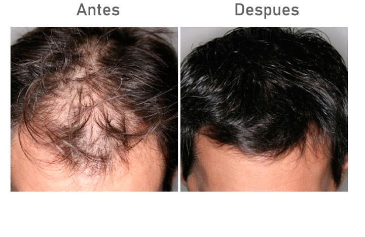 Antes despues